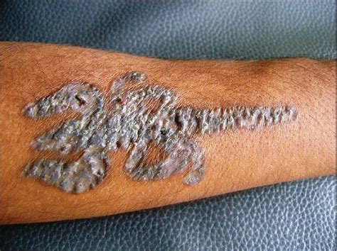 Granuloma Annulare Like Palisading As A Histological Reaction To A