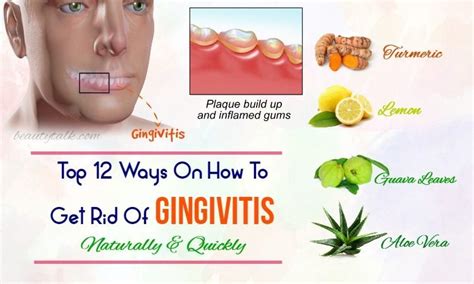 Top 12 Ways On How To Get Rid Of Gingivitis Naturally And Quickly