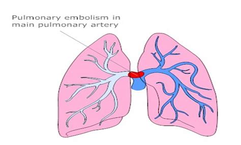 Saddle Pulmonary Embolism Diagram