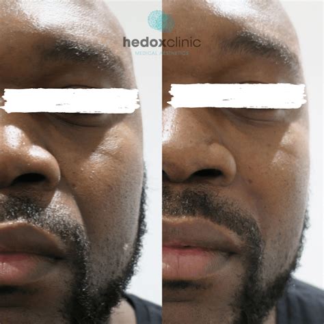 Nasolabial Folds Treatment London Nasal Fold Filler Hedox Clinic
