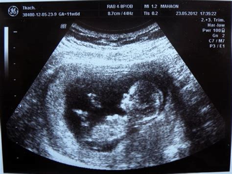 Baby S First Ultrasound 11 Weeks 1 Day Artofit