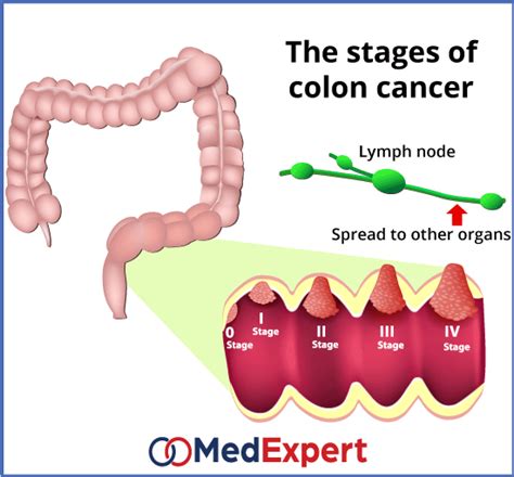 Colon Cancer Treatment Symptoms And Diagnostics Services Med Expert