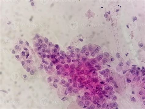 Microscopic View Of Trichomonas Vaginalis In Pap Smear With Few Acute