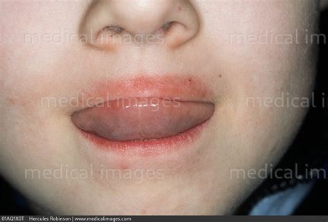 Stock Image Dermatology Perioral Dermatitis Red Inflamed Skin On The
