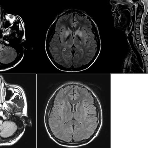Figure Brain Mri And Spine Mri Of The Patient On 6 Days After Onset Of