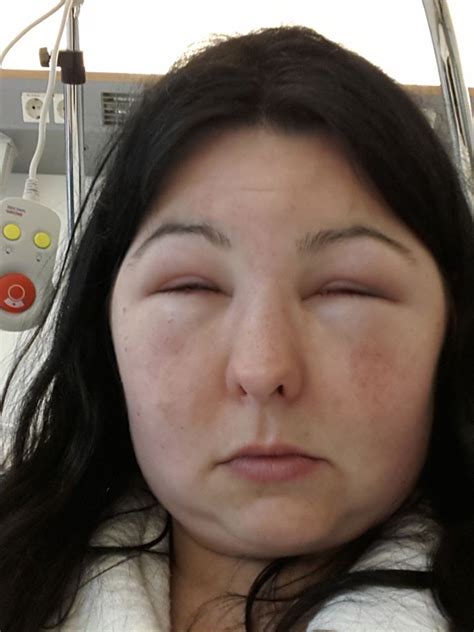 Severe Facial Swelling In A Pregnant Woman After Using Hair Dye Bmj