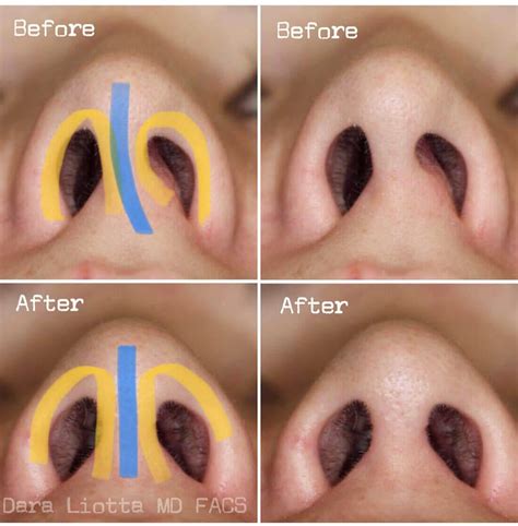 Nasal Reconstruction Archives Dr Dara Liotta