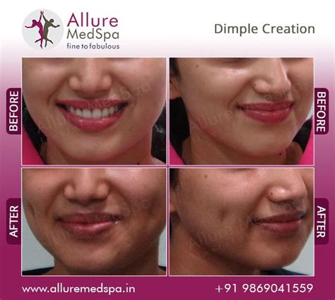 Dimple Creation Is The Most Common Aesthetic Surgery Used To Create
