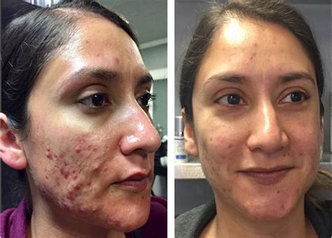 Professional Skincare Acne Before And Afters Rhonda Allison