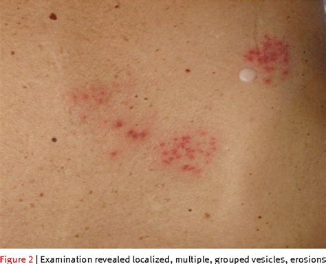 Figure 2 From Bortezomib And Bilateral Herpes Zoster Semantic Scholar