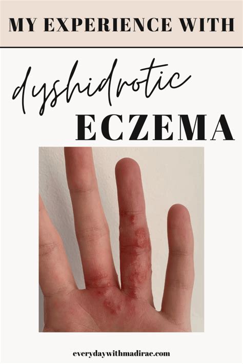 My Experience Dealing With Dyshidrotic Eczema Pompholyx Eczema Cure