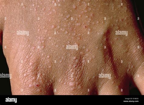 Papular Rash Stock Photo 52487321 Alamy