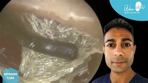 1126 Dead Skin Peel And Stripping From Ear Youtube