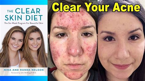 clear cystic acne with diet nina and randa youtube