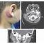 Branchial Cleft Cyst Causes Types Signs Symptoms Diagnosis & Treatment