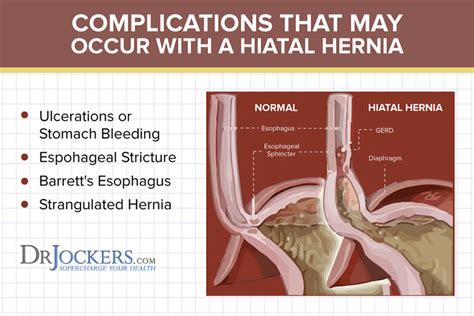 Hiatal Hernia What It Is And Natural Treatments
