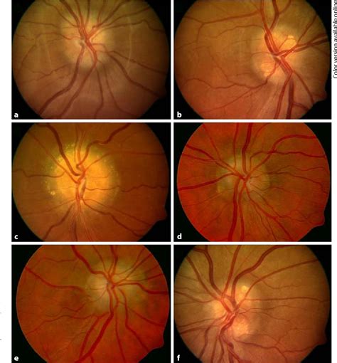 Optic Disc Hemorrhages In Glaucoma And Common Clinical Features 60f