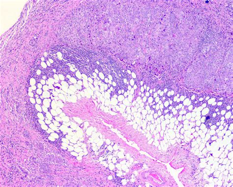 Pathology Outlines Mesothelioma Peritoneum Epithelioid