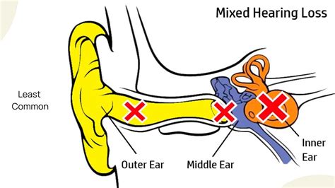 Most Common Types Of Hearing Loss Sensorineural Conductive And Mixed