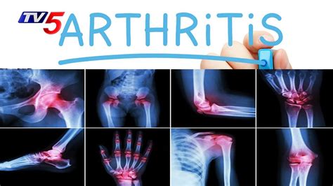 Arthritis Causes Types And Treatments Homeo Care International Good