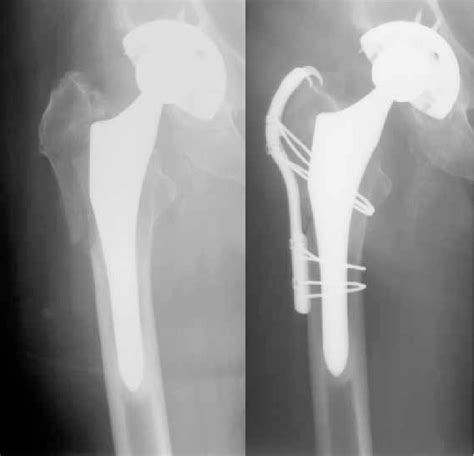 Greater Trochanter Fracture