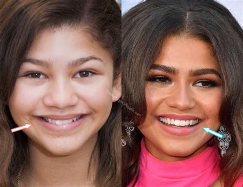 Zendaya Before And After 2022
