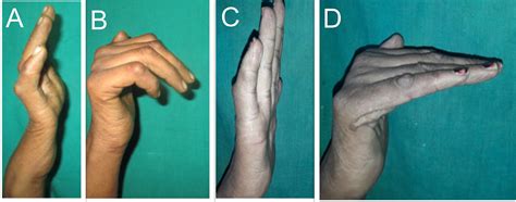 Dynamic Correction Of Ulnar Claw Hand Deformity With A Simple Insertion