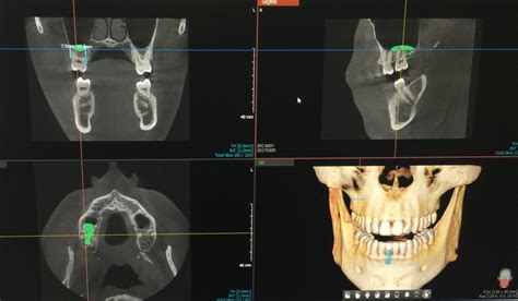 Torrance 3 D Ct Scans Cone Beam Palos Verdes Oral Surgery Implants