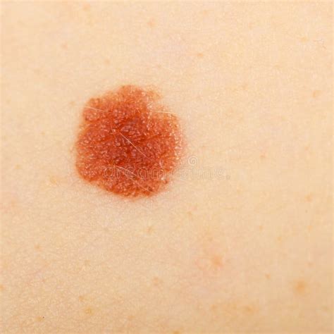 Closeup Brown Mole On Caucasian Woman Skin Stock Image Image Of