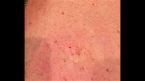 Pimple Popper Who Wants More Zit Popping Youtube
