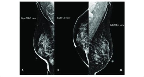 Mammogram Ab An Abnormal Density Shadow In The Lower Inner