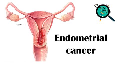 Endometrial Cancer Causes Risk Factors Signs And Symptoms Staging Diagnosis And Treatment