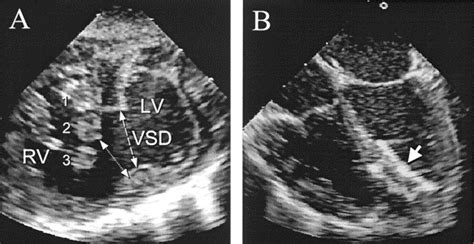 Perventricular Device Closure Of Muscular Ventricular Septal Defects On