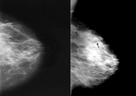 Carcinoma Ductal Invasivo Descrição De Um Caso Dr Pixel