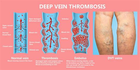 Deep Vein Thrombosis Diagnosis And Treatment San Diego