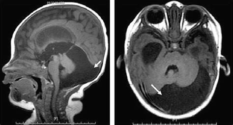 Images Of T1 Weighted Brain Magnetic Resonance Imaging Of The Neonate