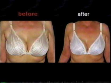 New Breast Lift Technology Pictures