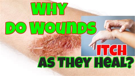 Why Do Wounds Itch As They Heal Youtube