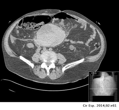 Spontaneous Mesenteric Hematoma A Diagnostic Challenge Cirugía