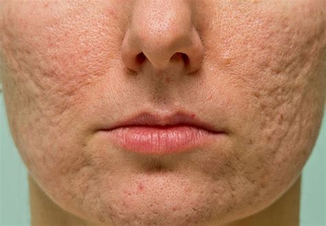top 3 ways to get rid of acne scars cleveland clinic