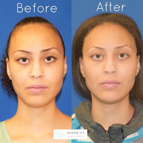 Before And After Of Botox In The Masseter Muscle And Filler In The Jaw