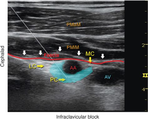 Ultrasound Guided Infraclavicular Brachial Plexus Block Hadzics