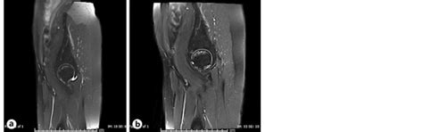 A Sagittal Stir Short T1 Inversion Recovery Of The Left Hip Joint