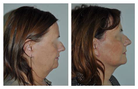 mini lift pour redéfinir les contours du bas du visage et du cou
