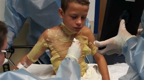 ‘fire Challenge Leaves 12 Year Old Boy With 2nd Degree Burns