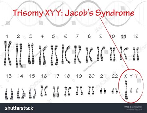 Jacob Syndrome Karyotype