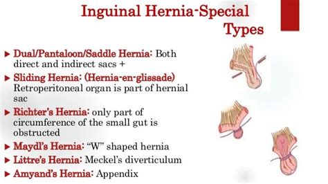 Inguinal Hernia Groin Swellings