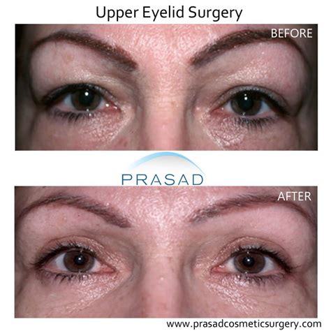 Hooded Eyelid Surgery Benefits Results And Recovery
