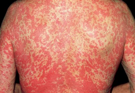 Rash Due To Allergy Photograph By Dr P Marazziscience