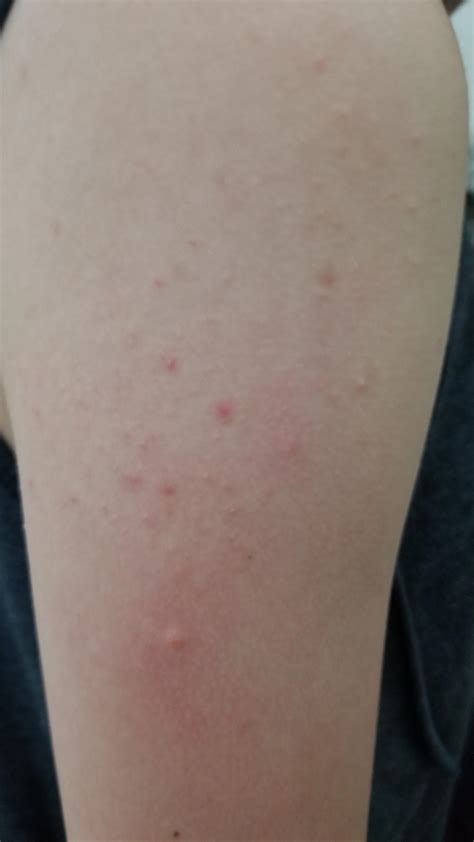 Fungal Acne On Arms After Epilating Acne